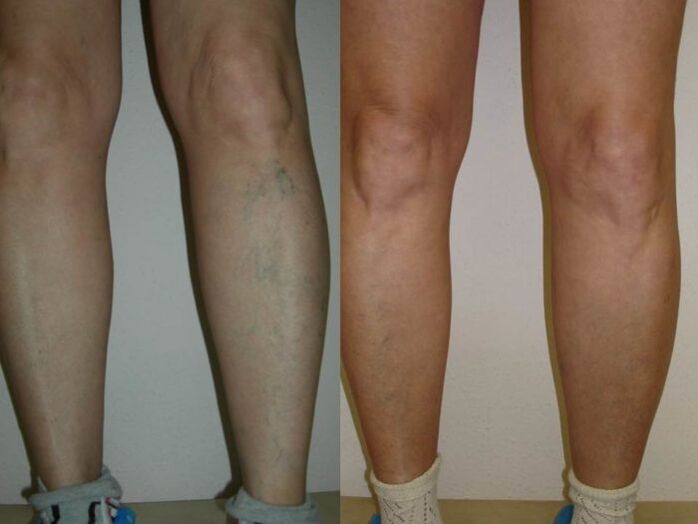 jalad enne ja pärast veenilaiendite laserravi