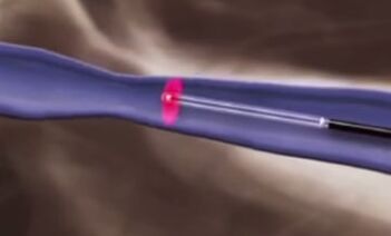 Termilised protseduurid